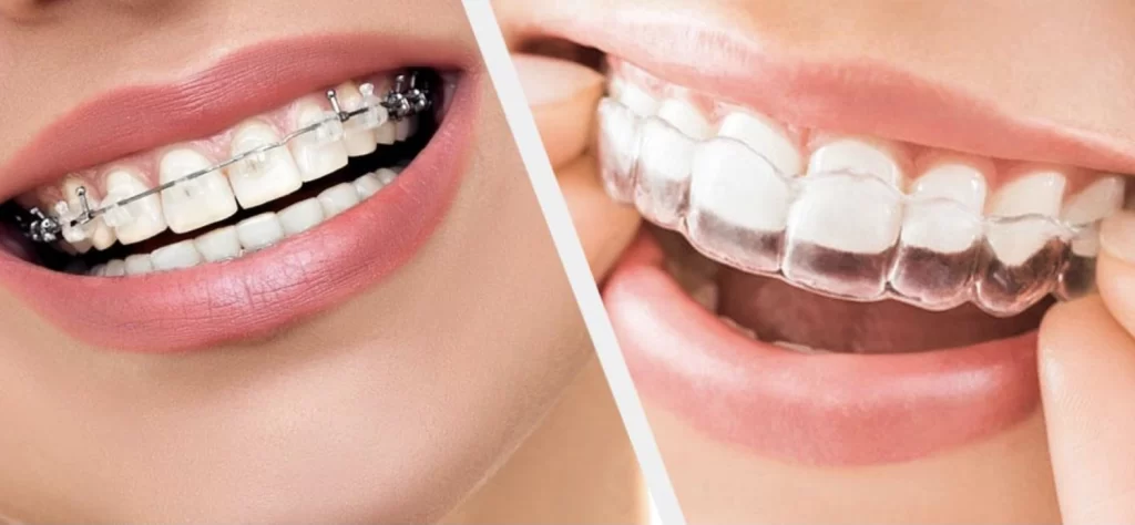 Orthodontics In Ravet, Punawale, Wakad, Hinjewadi, Marunji