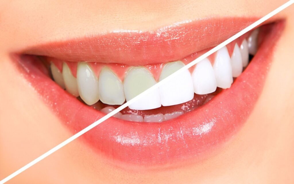 Teeth Whitening In Ravet, Punawale, Wakad, Hinjewadi, Marunji